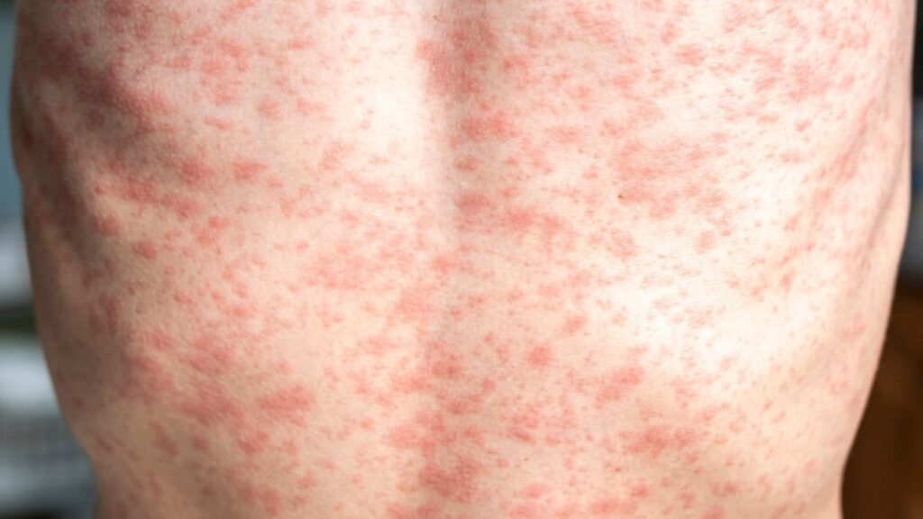 measles-rf-gty-ml-250225_1740493327902_hpMain_16x9.jpg